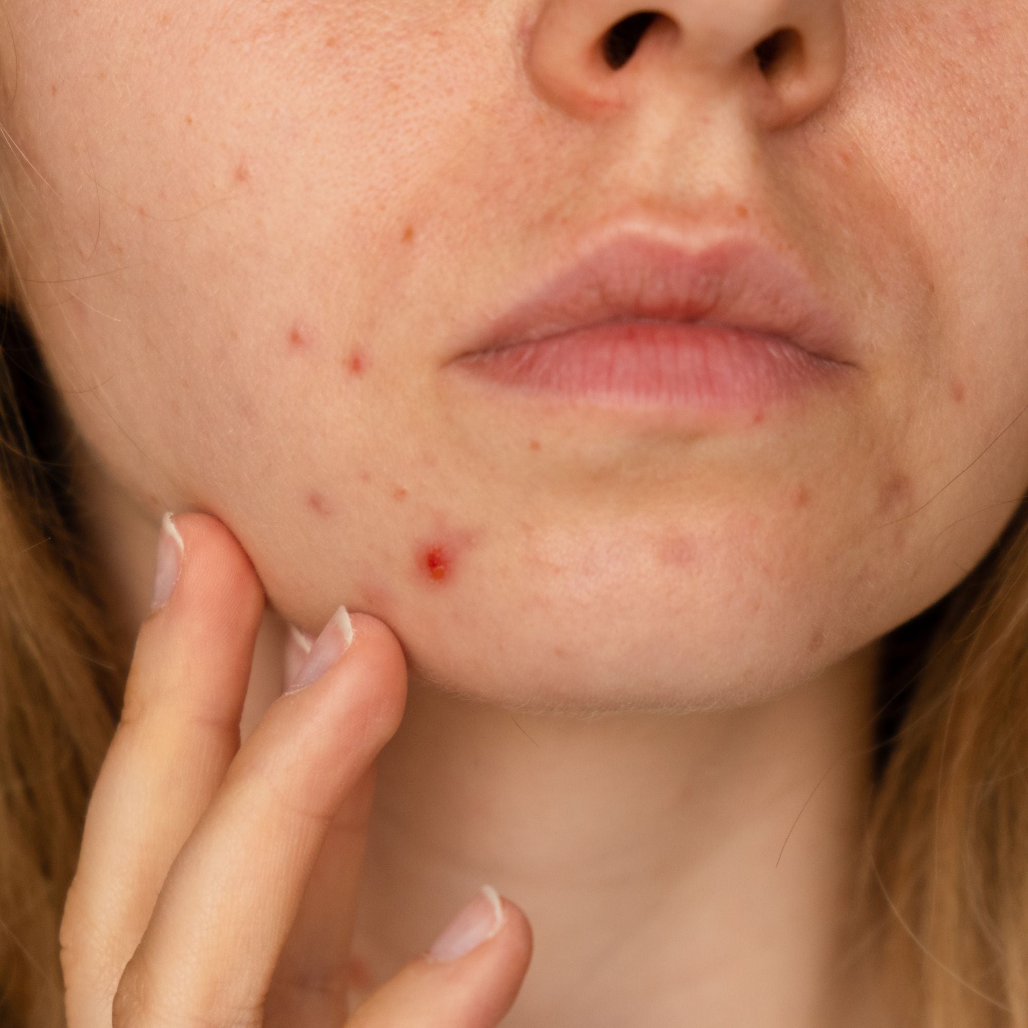 All About Infected Pimples And How To Deal With Them