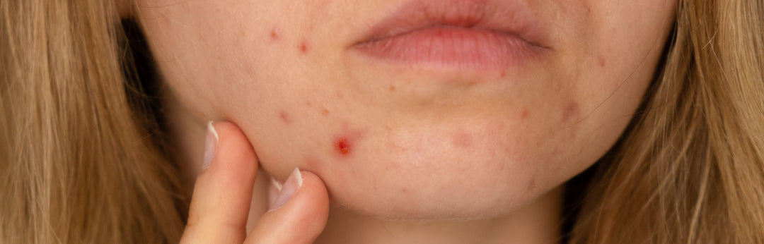 Exploding Infected Pimples Dealing with Infected Pimples: Tips & Treatment – MulSecrets