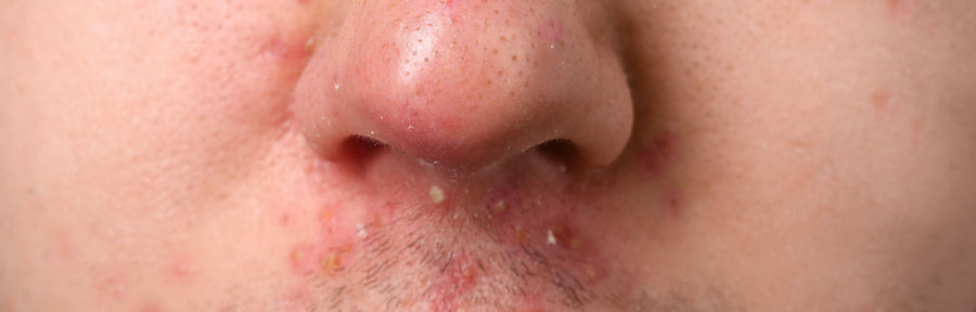 Comedonal Core Understanding Comedonal Acne: Causes & Treatment Options – MulSecrets